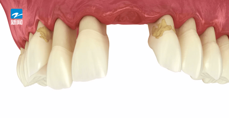 皇冠信用盘登123出租_44岁女子牙齿掉光皇冠信用盘登123出租!只因这个很多人都忽视的“小问题”……